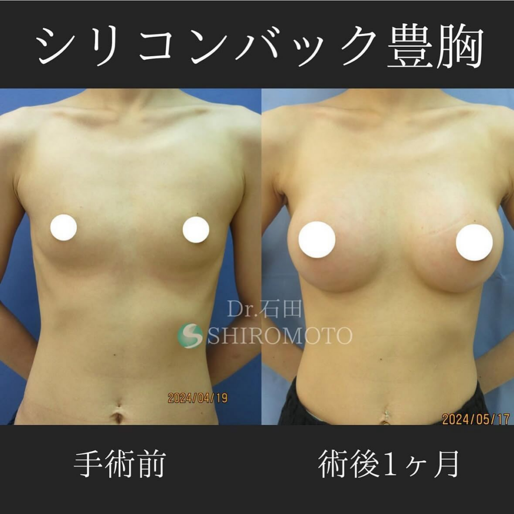 シリコンバック豊胸(術前・術後)①
