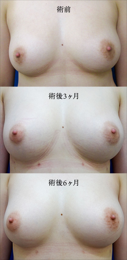 シリコンバック豊胸(術前・術後)②