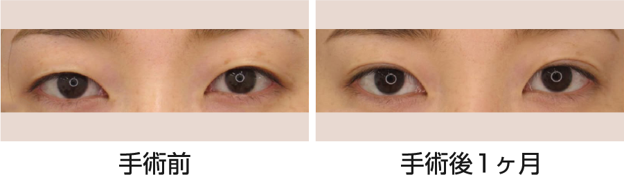 幅の狭いナチュラルな二重