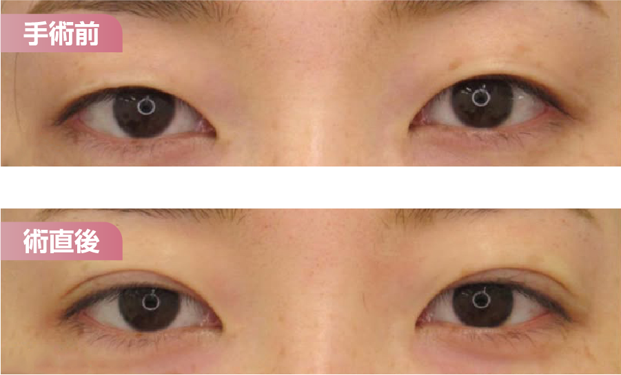 手術直後でもほとんど腫れが気にならない