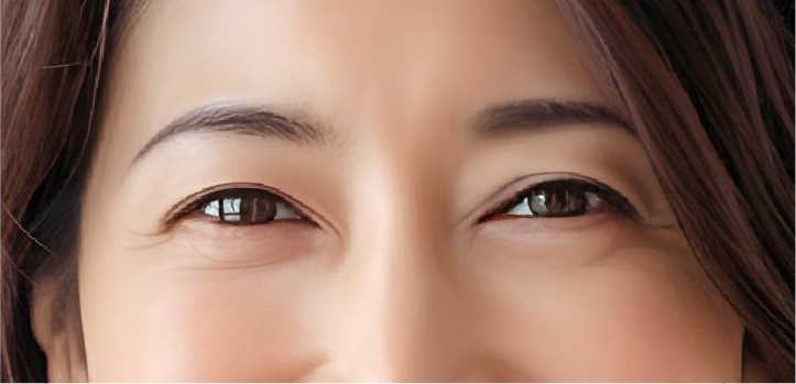 注射による切らない施術