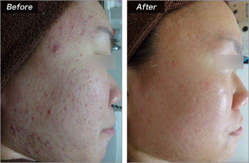 にきび にきび跡の治療の美容皮膚科なら城本クリニック