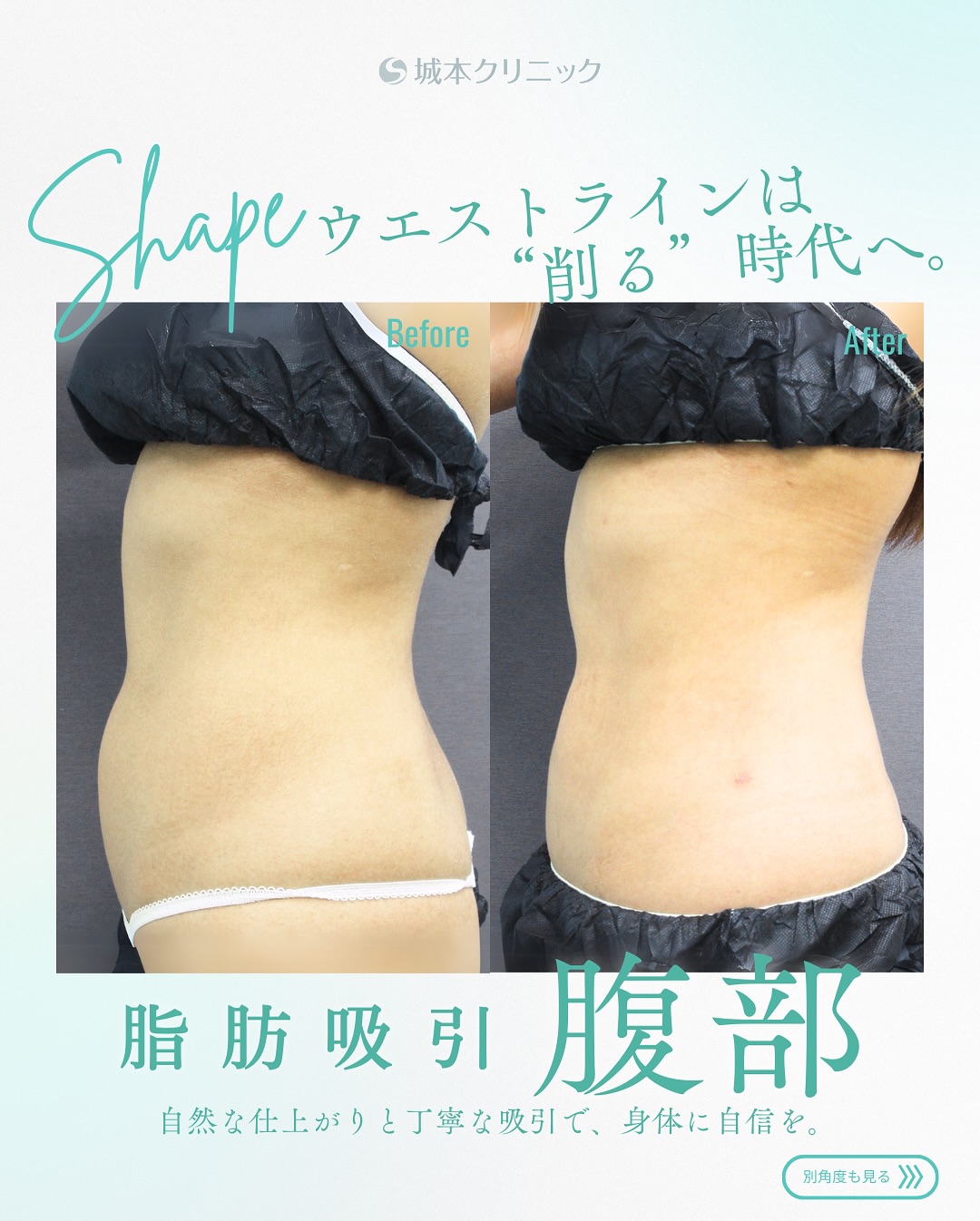 お腹の脂肪吸引の症例写真