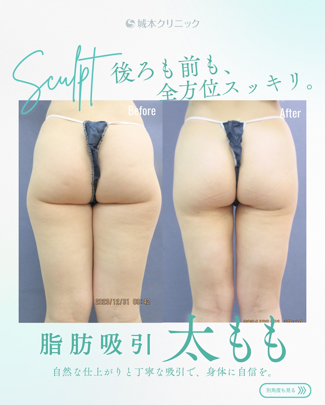 太ももの症例写真