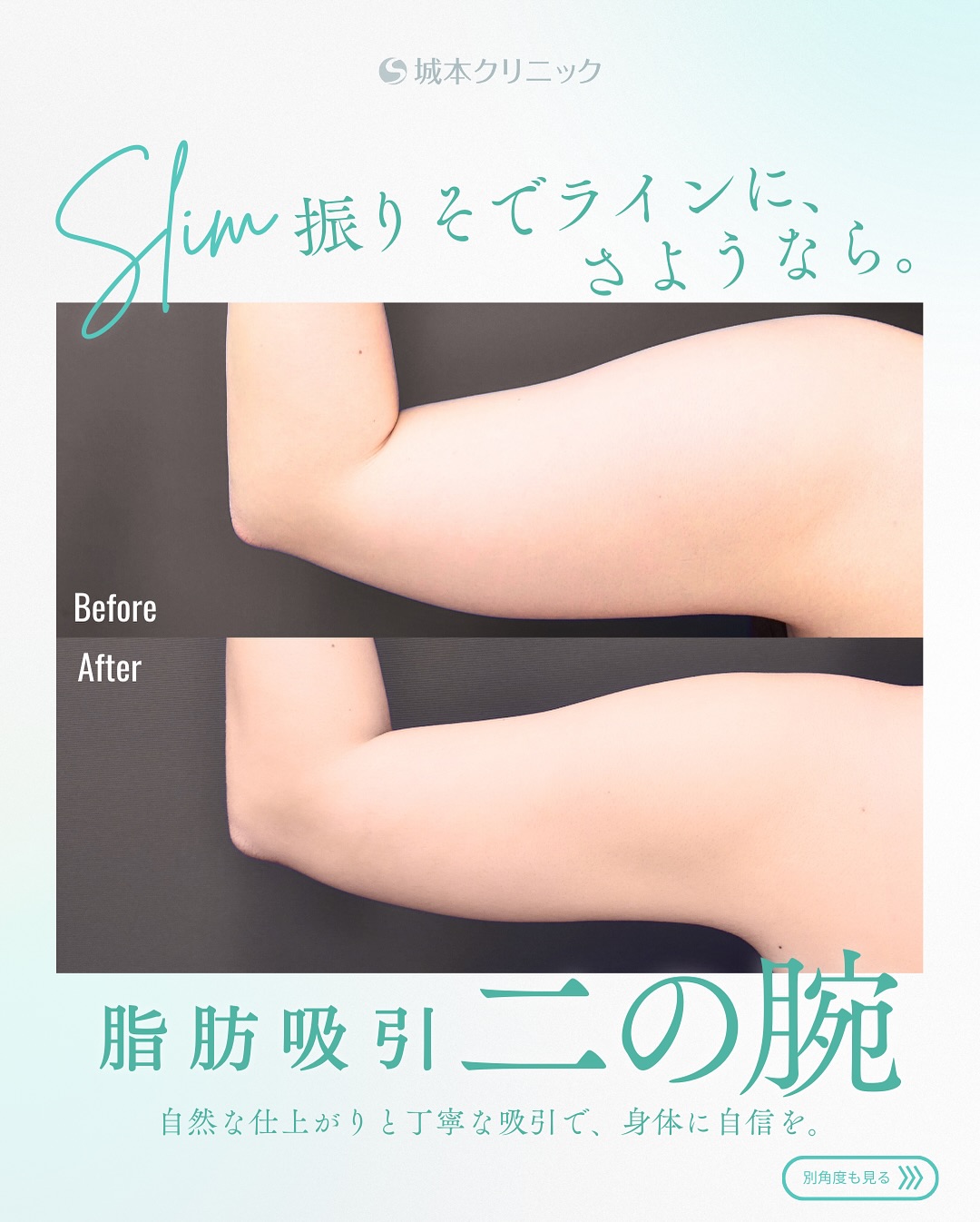 脂肪吸引(二の腕)の症例写真