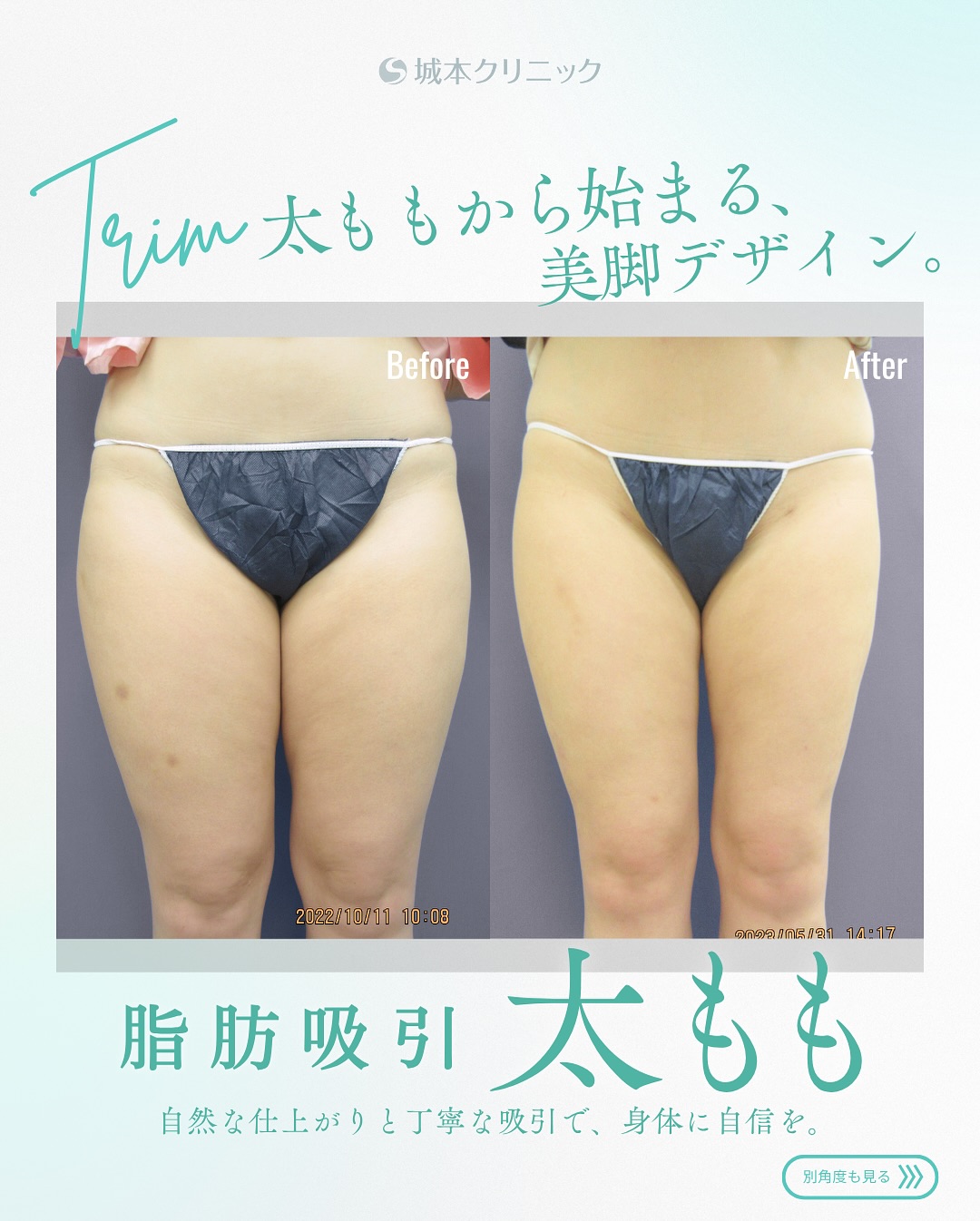 太ももの症例写真