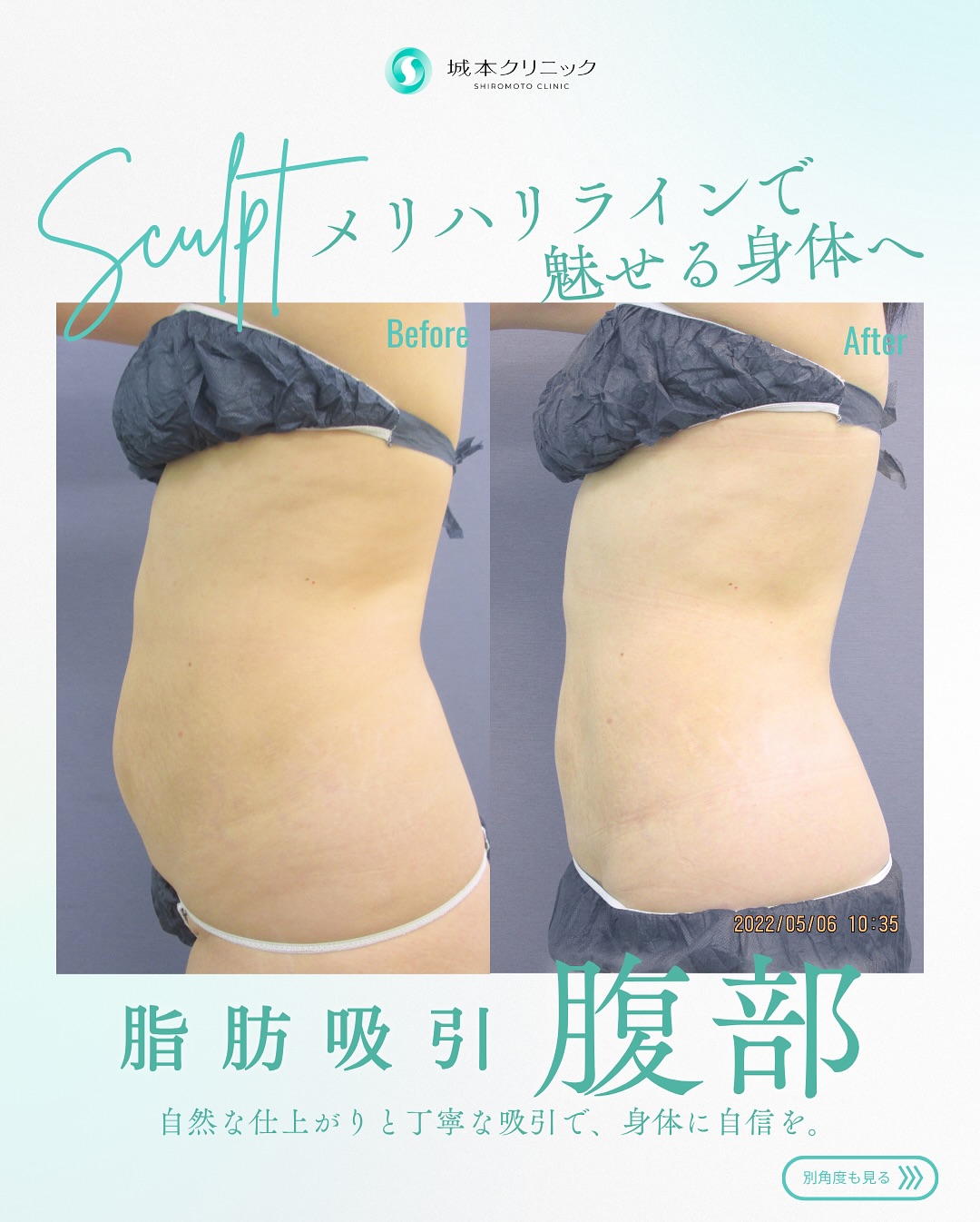 お腹の脂肪吸引の症例写真