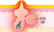 膿疱(のうほう):膿ニキビ(イラスト解説)