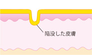 ニキビ跡:クレーター(イラスト解説)